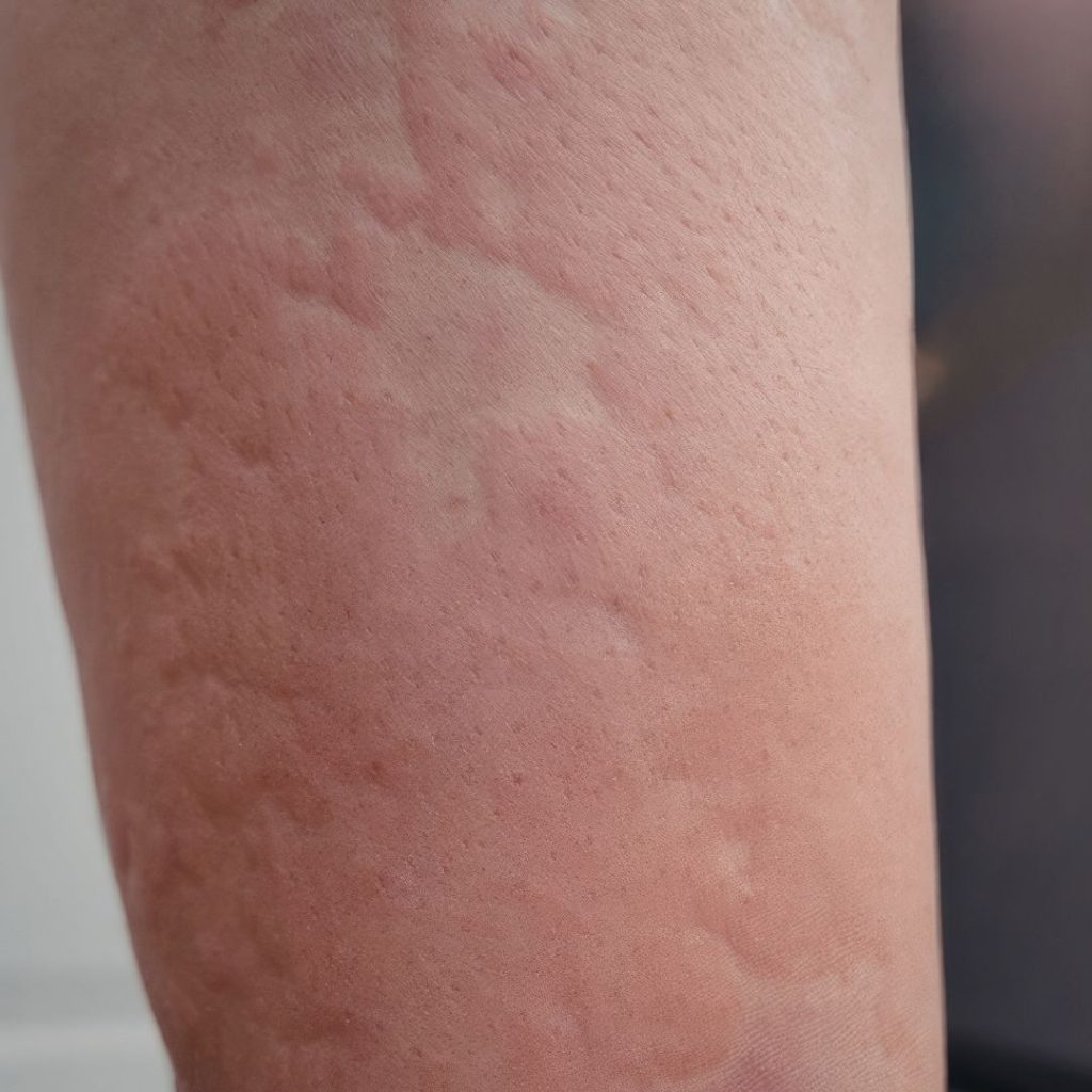 Hives on an arm, a common symptom of SIBO and histamine intolerance
